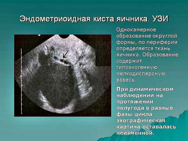Эндометриоидная киста яичника (левого, правого): беременность, лечение 