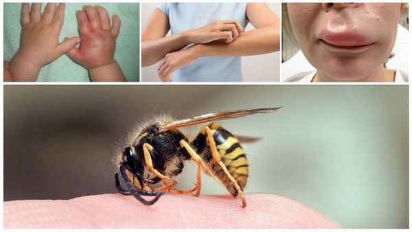 Что делать, если ребенка укусила оса, пчела, шмель? 