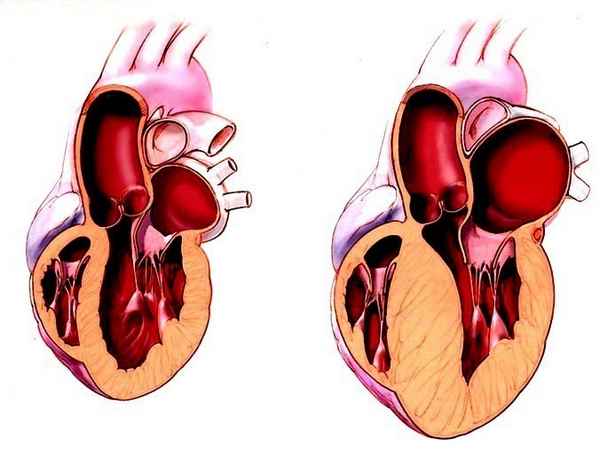 Гипертензия правого желудочка сердца