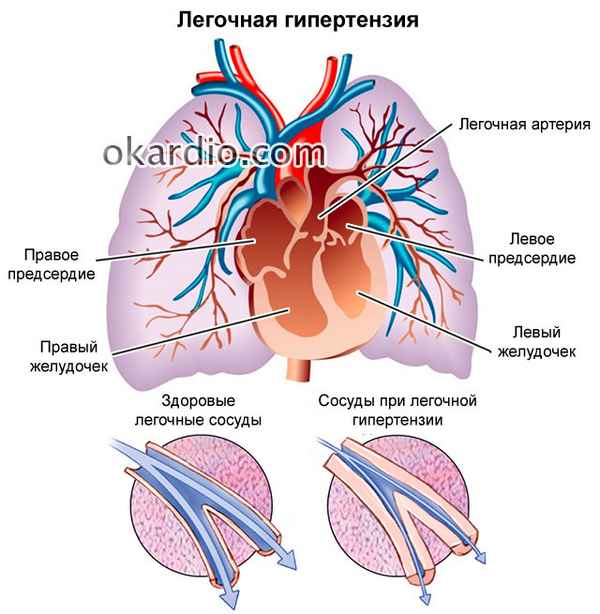 Гипертензия легочной артерии симптомы