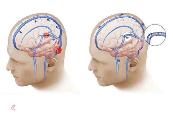 Гипертензия сосудов головного мозга симптомы