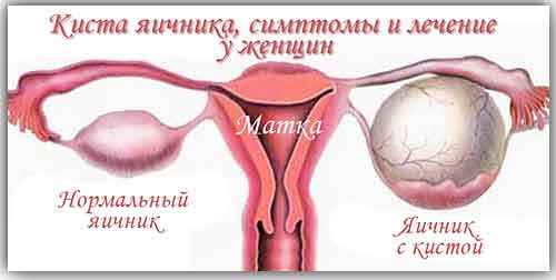Киста яичника симптомы и лечение женщины. Различные взгляды