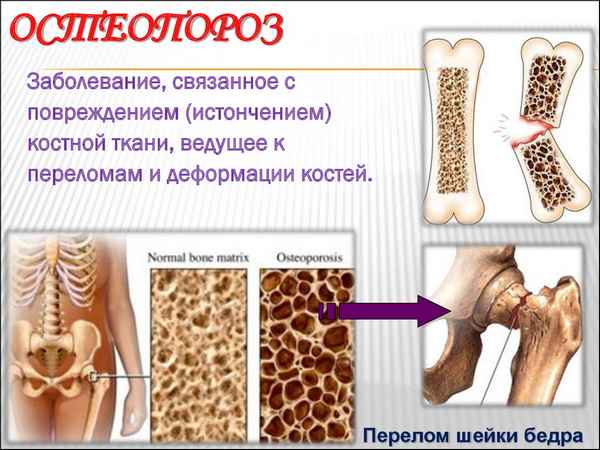 Остеопороз что это такое как лечить, почему ломаются кости