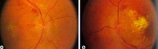 Глазное дно при гипотонии