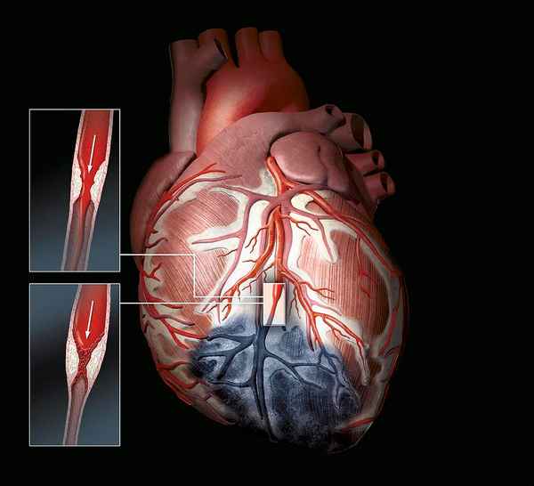 Что такое обширный инфаркт сердца