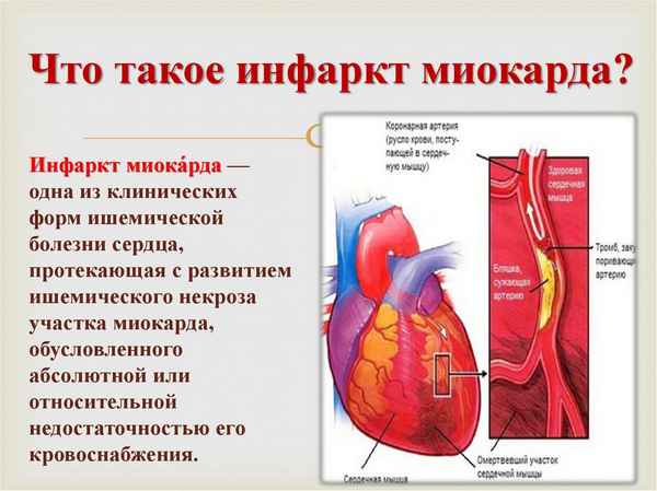 Что такое обширный инфаркт и его последствия