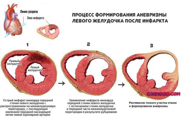 Аневризма левого желудочка после инфаркта