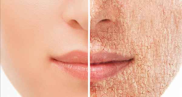 Шелушится кожа на лице и сохнет: что делать, если очень сухая и обезвоженная кожа лица, как избавиться от шелушения, диагностика, маски для сухой кожи лица