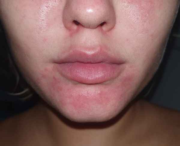 Как выглядит аллергия на подбородке - причины, симптомы и лечение