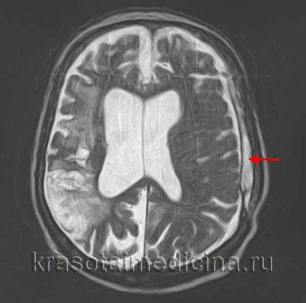 СубДypaльная гигрома головного мозга у ребенка: методы лечения, код по МКБ-10