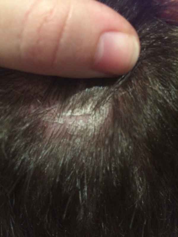 Болячки на голове - коросты в волосах, почему чешется голова, причины и чем лечить у ребенка и у взрослых, фото