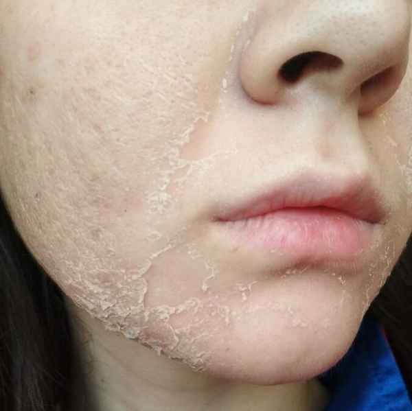 Шелушится кожа на лице - что делать и как устранить?
